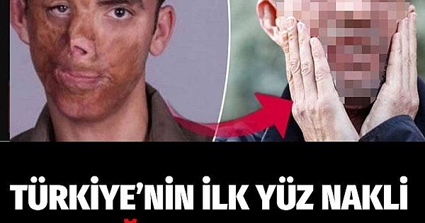 Türkiye'nin ilk yüz nakli Uğur Acar'ın 2019'da son hali yüz naklinde 8 yıl geride kaldı! İşte son hali