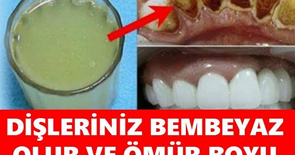 2 Dakika İçinde Sarı Dişleriniz Bembeyaz Olur Ve Ağız Kokusundan Ömür Boyu Kurtulursunuz