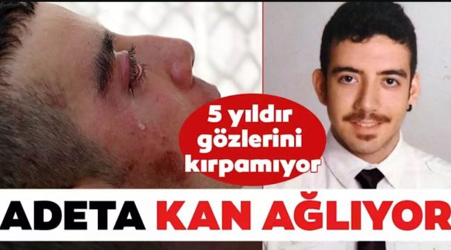 5 yıldır göz kapaklarını kapatamıyor! Kan ağlıyor