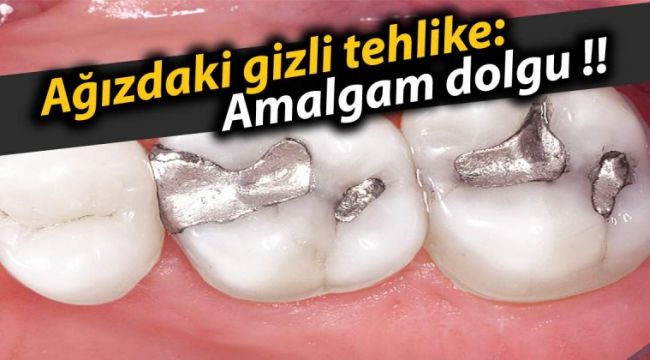 Ağızdaki gizli tehlike, Amalgam dolgu !!