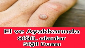 Siğil Nedir? / Tedavisi